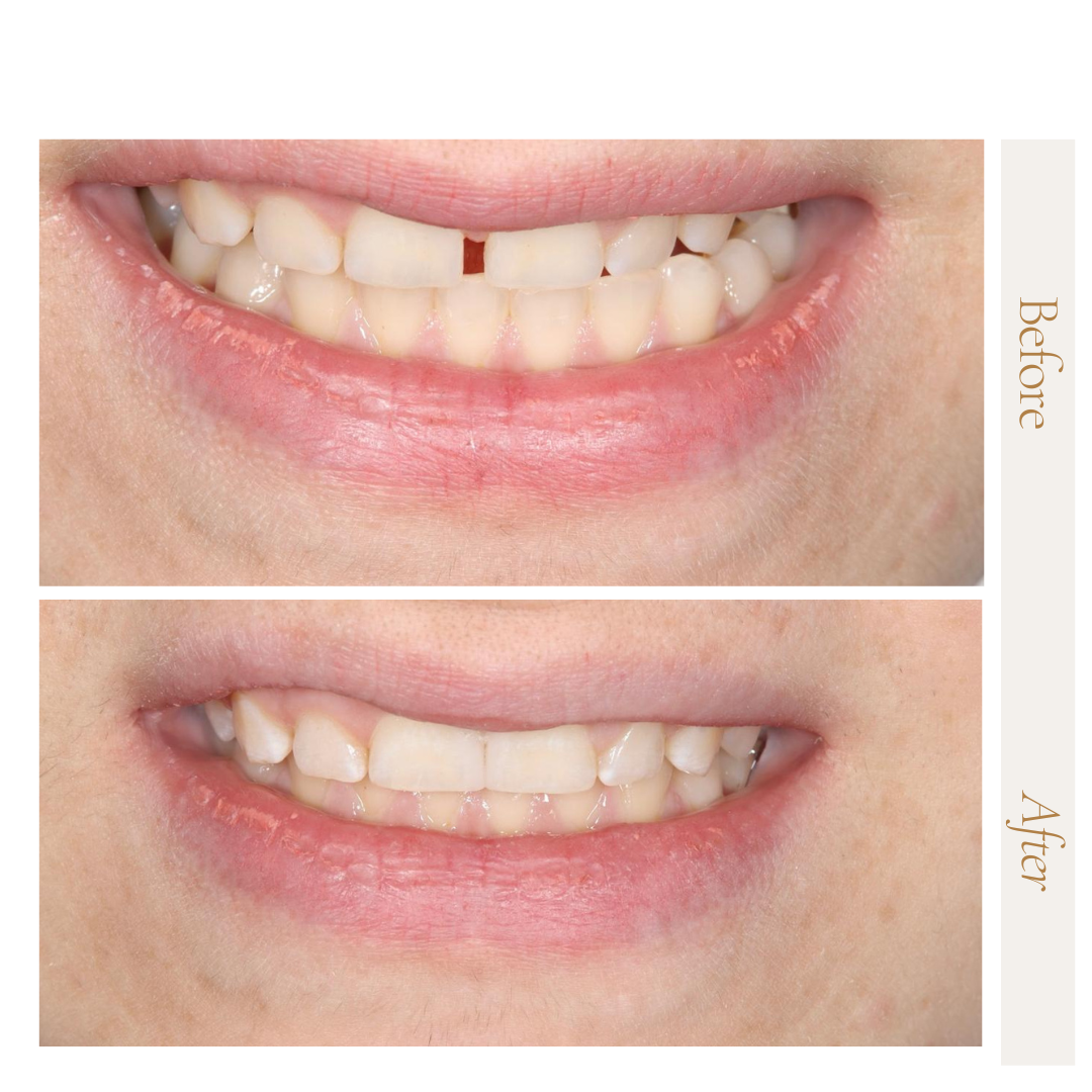 حشوات تجميليه